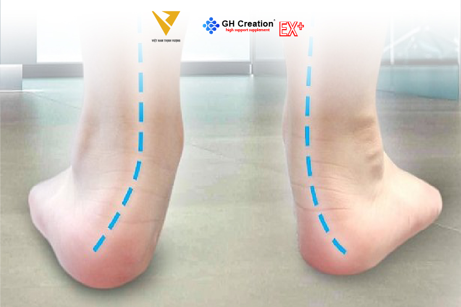 Tình trạng chân khoèo và ảnh hưởng đến chiều cao của trẻ Tình trạng chân khoèo và ảnh hưởng đến chiều cao của trẻ